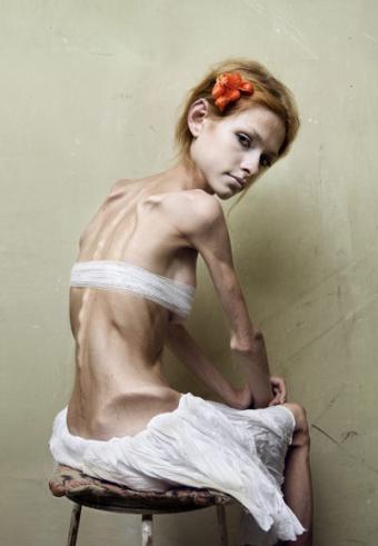 The developmental perspective on anorexia is pretty simple in its 